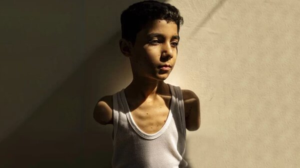 دستهایی که بدون بیهوشی قطع شدند | تصاویر