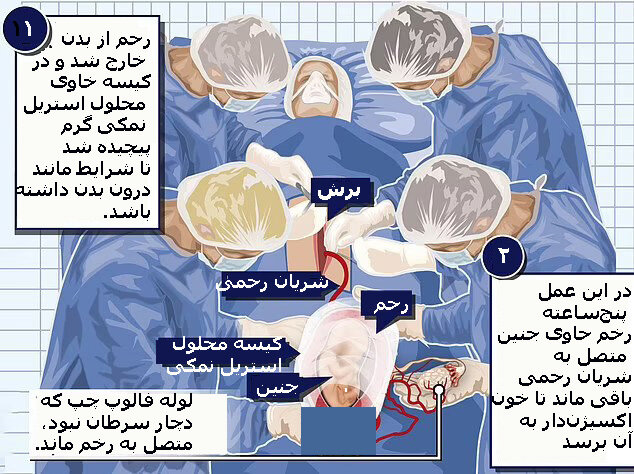 یک معجزه پزشکی | این نوزاد دو بار متولد شد!