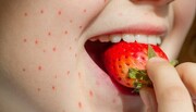 حساسیت به توت فرنگی چه علائمی دارد؟