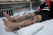 جراحی افزایش قد چگونه است ؟ ؛ مدت نقاهت و محدودیت‌های حرکتی پس از جراحی افزایش قد