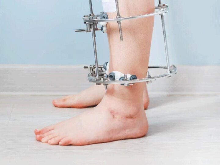 جراحی افزایش قد چگونه است ؟ ؛ مدت نقاهت و محدودیتهای حرکتی پس از جراحی افزایش قد