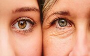 تاثیر آنتی‌ اکسیدان بر پیری زودرس