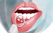 مراقبت خانگی برای مقابله با آفت دهان