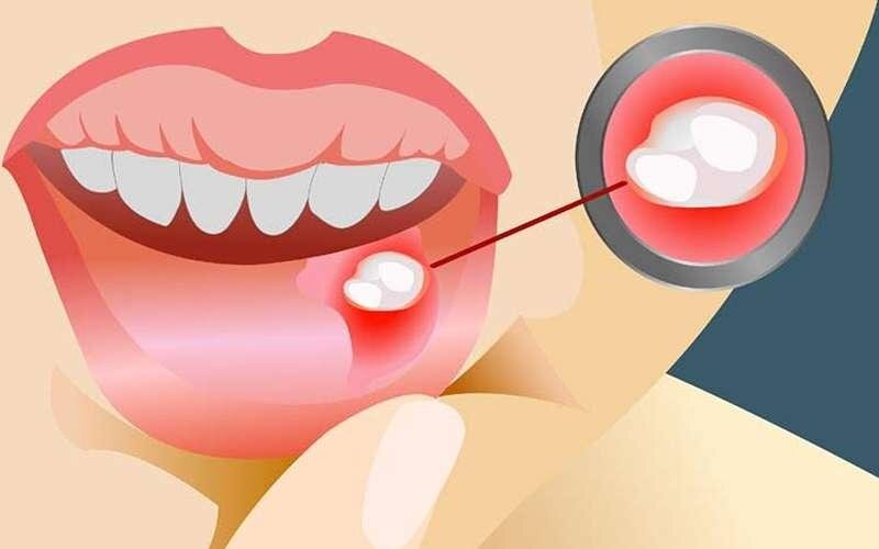 مراقبت خانگی برای مقابله با آفت دهان