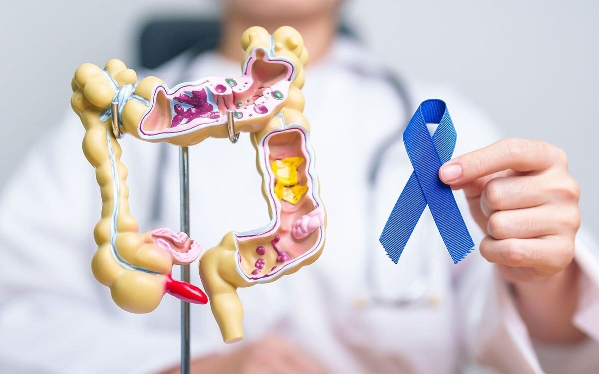 درباره سرطان روده بزرگ چه می‌دانید؟ | علائم، مراحل گسترش خطر، علل و انواع درمان