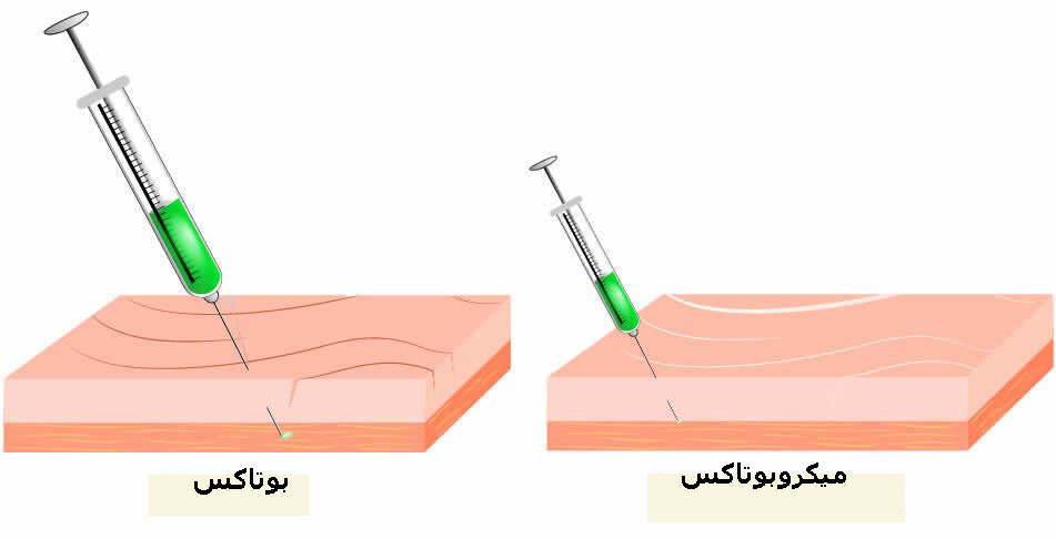 میکروبوتاکس برای چه کسانی مناسب است؟ | چه تفاوتی با بوتاکس دارد؟
