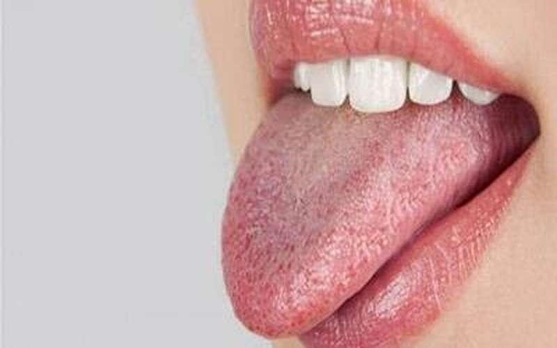 زبان سفید چه چیزی درباره سلامت می‌گوید؟