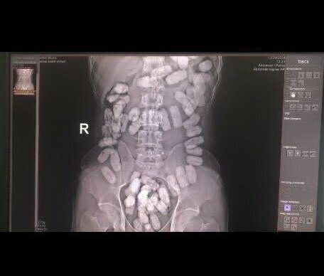 ۵۵ بسته هروئین از معده یک نفر در خراسان کشف شد | تصاویر