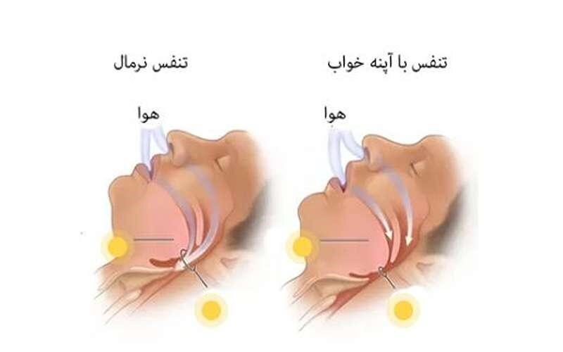 چرا صبحها با سردرد از خواب بیدار میشویم؟