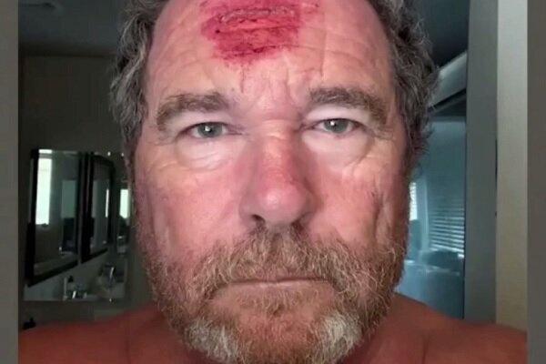 اصابت گلوله به پیشانی عکاس نیویورک پست! + ویدئو | تصویر عکاس بعد از اصابت