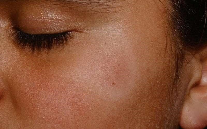 علت لکههای سفید روی پوست کودکان و روشهای درمان آن