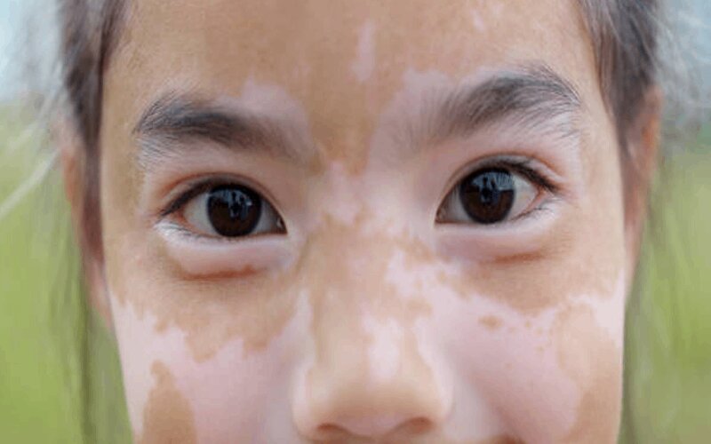 علت لکههای سفید روی پوست کودکان و روشهای درمان آن