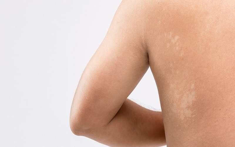 علت لکههای سفید روی پوست کودکان و روشهای درمان آن