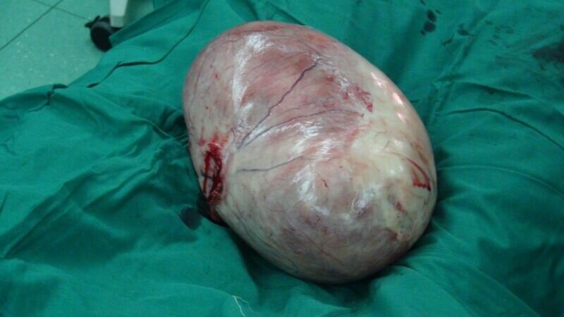 تومور ۲۰ کیلویی چطور داخل بدن یک انسان جا میشود؟ | بلایی که این تودهها بر سر اندامهای داخلی میآورند