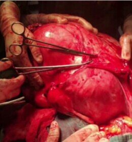 تومور ۲۰ کیلویی چطور داخل بدن یک انسان جا میشود؟ | بلایی که این تودهها بر سر اندامهای داخلی میآورند