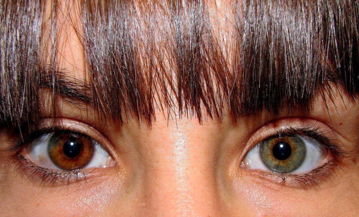 چرا چشمهای برخی از افراد دو رنگ است؟