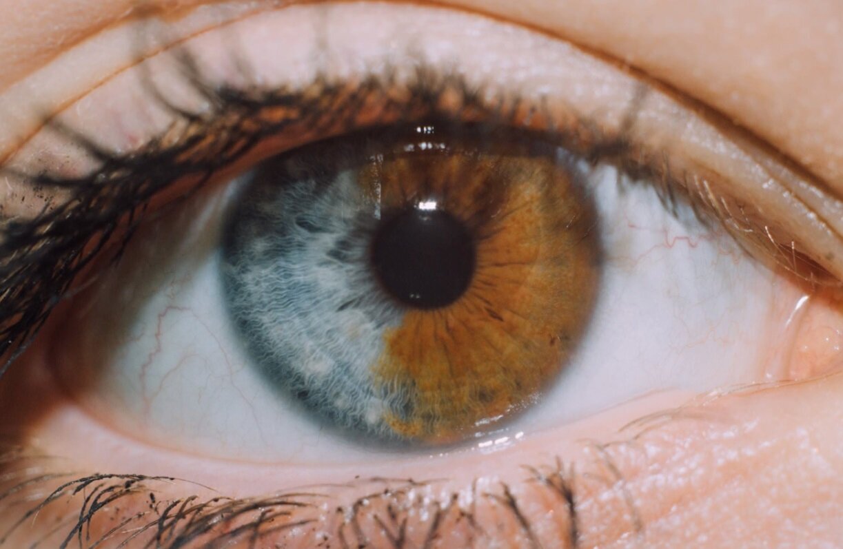 چرا چشمهای برخی از افراد دو رنگ است؟
