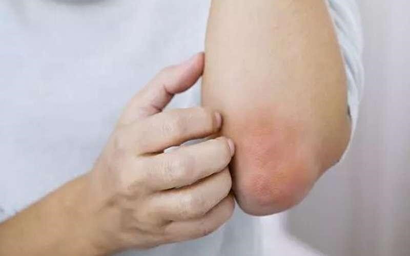 تیرگی زانو و آرنج