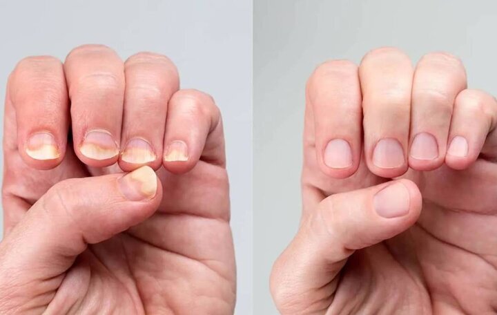 این ۷ نشانه در ناخن یعنی کلسترول شما بالا رفته است