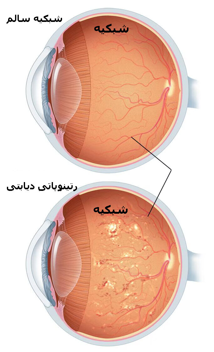 درمان آسیب چشم دیابتیها با هوش مصنوعی