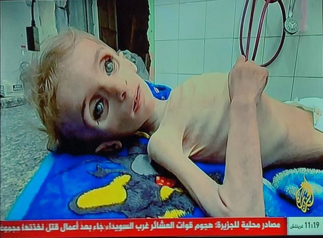 تصاویر وحشتناک از غزه که قلب را به درد میآورد | جان باختن کودکی دیگر در غزه بر اثر سوء تغذیه
