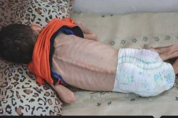 تصویر بسیار درناک از شهادت کودک فلسطینی به دلیل گرسنگی | عکس