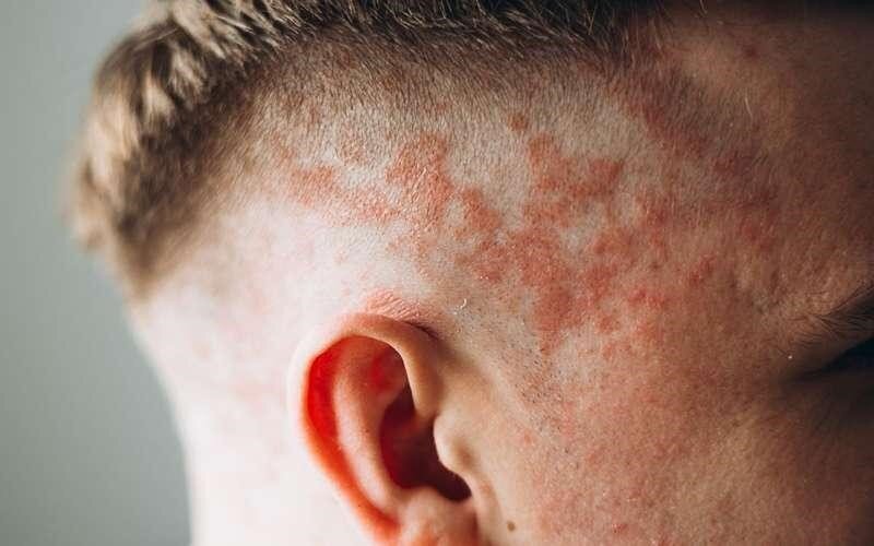 اگزمای پوست سر چیست و چطور درمان می‌شود؟
