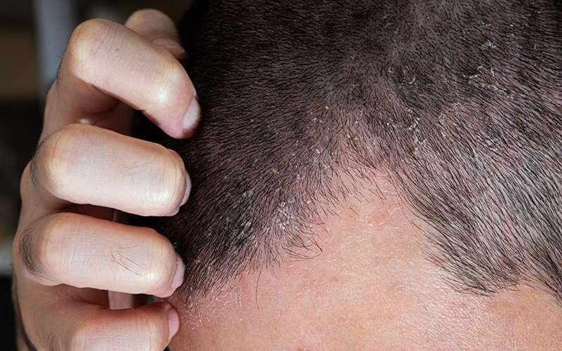 اگزمای پوست سر چیست و چطور درمان می‌شود؟