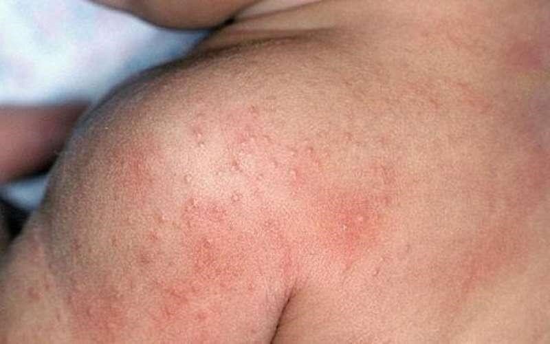 عرق‌سوز شدن گردن نوزاد در تابستان؛ روش‌های پیشگیری و درمان خانگی