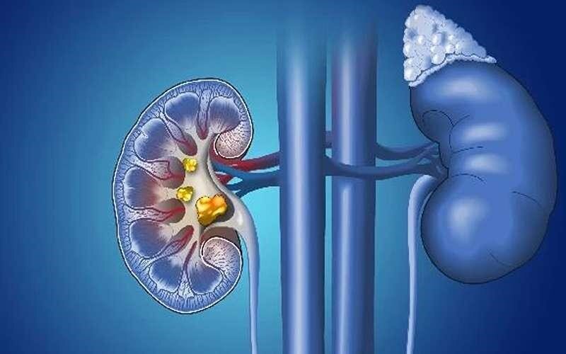 درمان کلیه