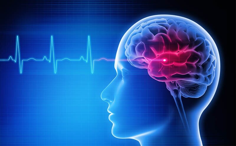 راهکارهای پیشگیری از سکته مغزی | وضعیت خیم ایران در زمینه سکته مغزی