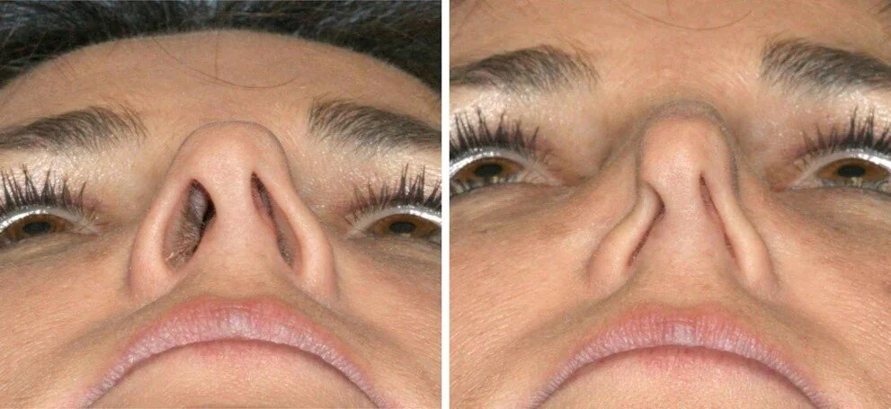 مشکلات تنفسی بعد از عمل بینی و راهحلها