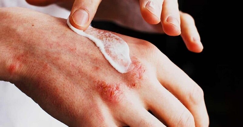 با این علائم اگزمای شدید آشنا شوید | چطور درماتیت اتوپیک را درمان کنیم؟