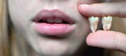 دندان عقل از چه سنی رشد می کند؟