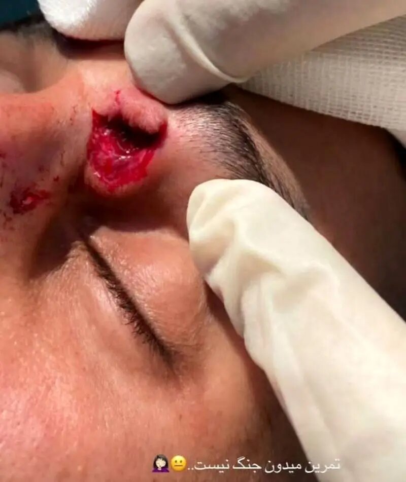 پارگی صورت و مصدومیت خطرناک علیپور در تمرین پرسپولیس | عکس