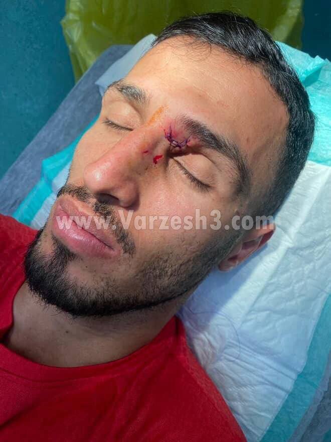 تصویری از وضع مصدومیت چشم علی علیپور | ببینید