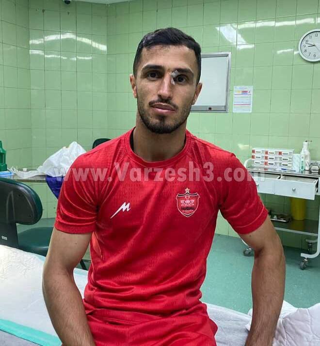 تصویری از وضع مصدومیت چشم علی علیپور | ببینید