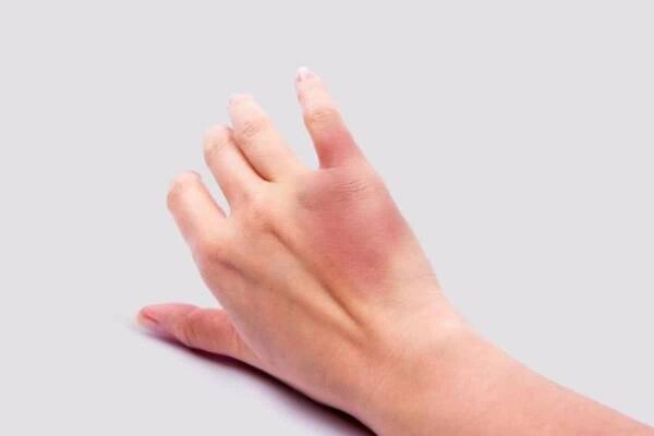 معنی هر یک از رنگهای کبودی بدن چیست؟ چه وقت باید نگران کبودی شویم ؟