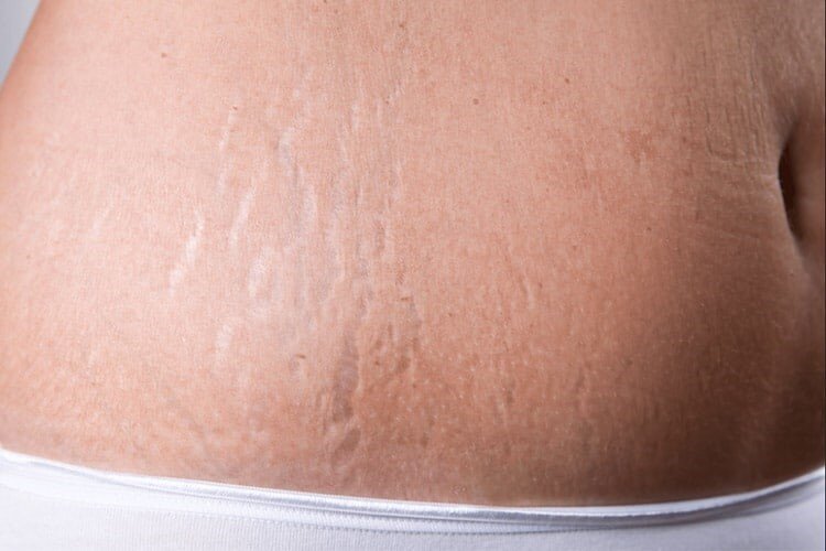 درمان ترک شکم بعد زایمان