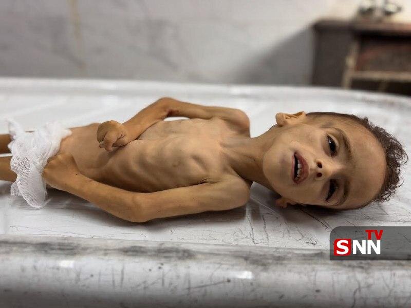 محمد ۵ ساله در غزه با وزن ۳ کیلوگرم جان داد؛ نماد دردناک قحطی و بیتوجهی جهانی