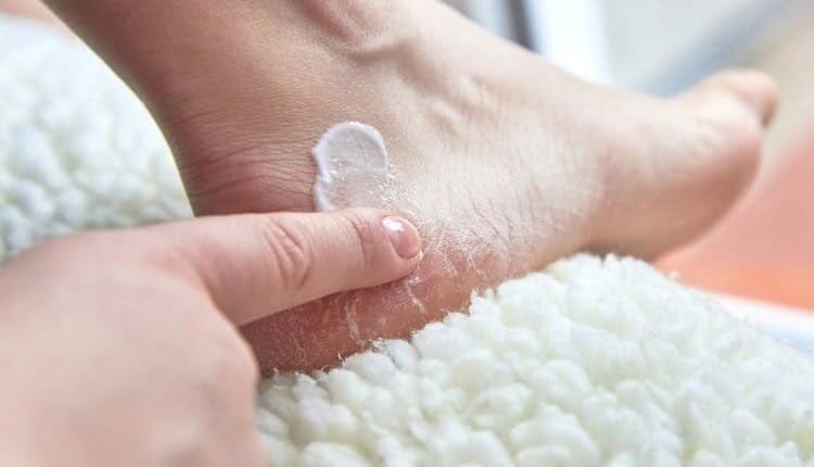 طرز تهیه کرم خانگی برای رفع ترک پا با مواد طبیعی