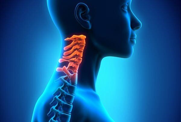 آرتروز گردن یا اسپوندیلوز گردنی چیست؟