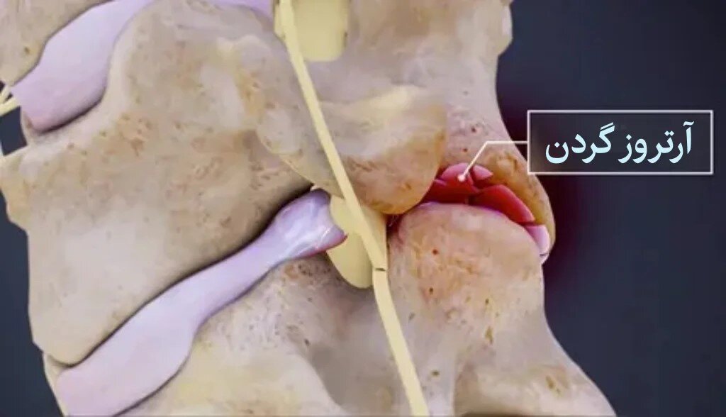 آرتروز گردن یا اسپوندیلوز گردنی چیست؟