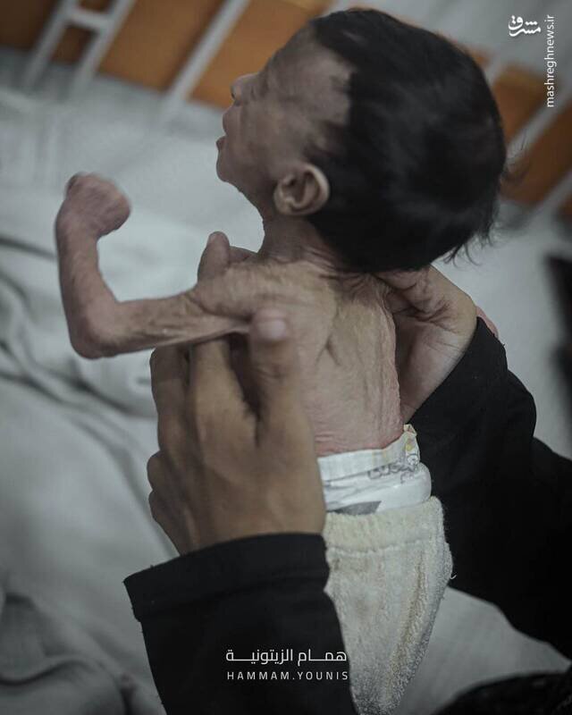 تصاویری از کودک چهارماهه غزهای در معرض سوءتغذیه شدید | تصاویر