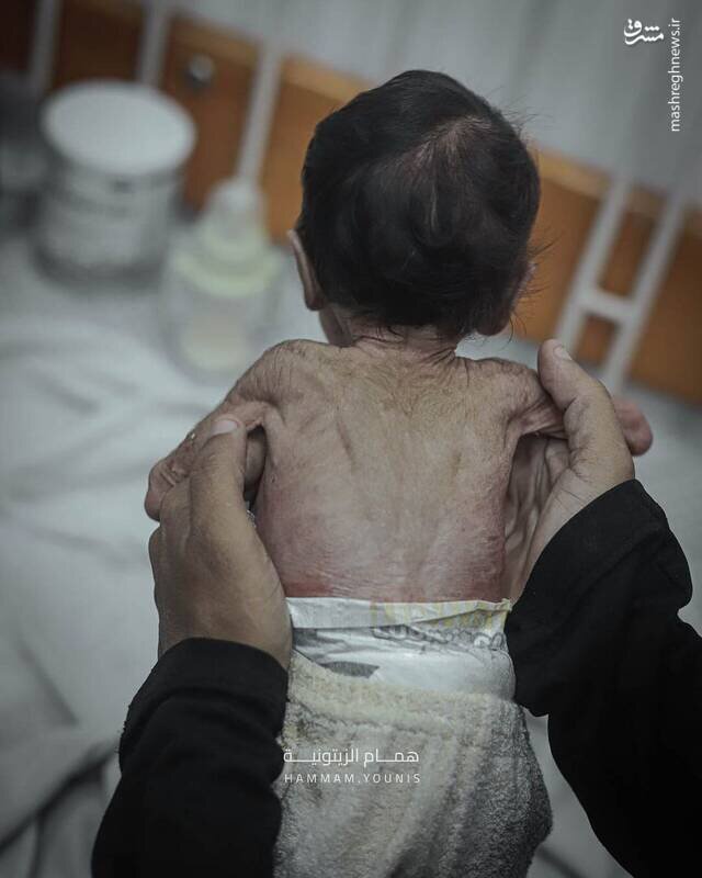 تصاویری از کودک چهارماهه غزهای در معرض سوءتغذیه شدید | تصاویر