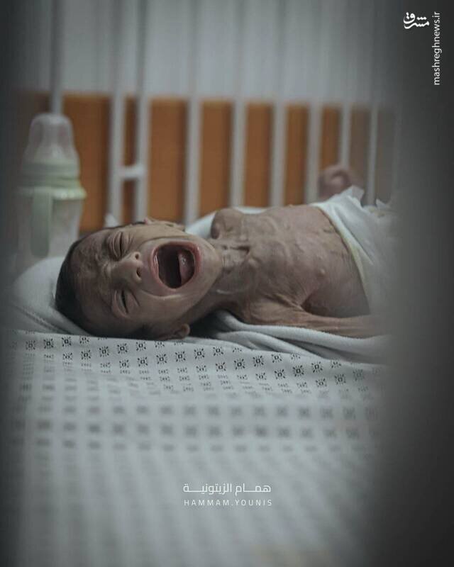 تصاویری از کودک چهارماهه غزهای در معرض سوءتغذیه شدید | تصاویر