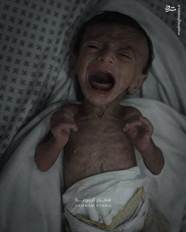 تصاویری از کودک چهارماهه غزهای در معرض سوءتغذیه شدید | تصاویر