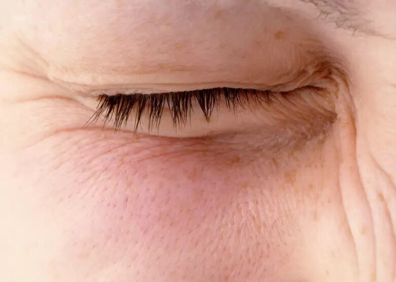 پرش پلک یا تیک عصبی چشم؛ علت، علائم و روشهای درمان