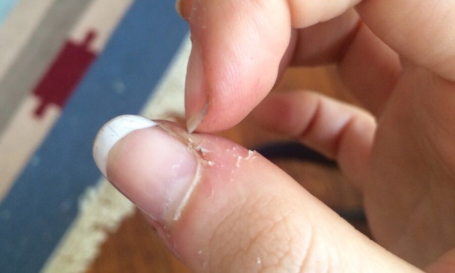 علت پوستپوست شدن اطراف ناخن و روشهای درمان