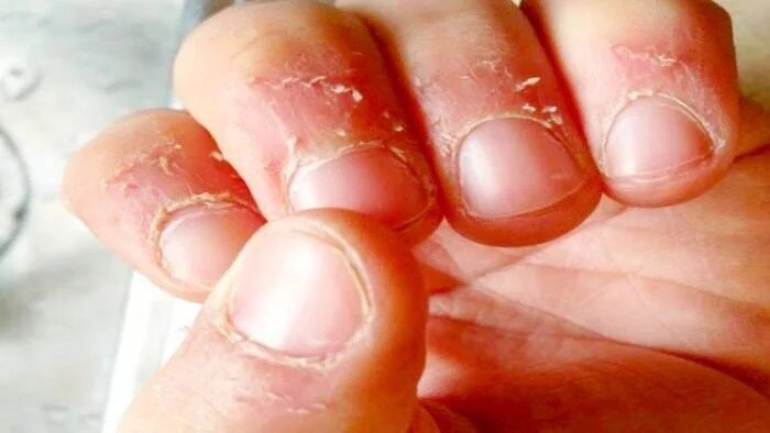 علت پوست‌پوست شدن اطراف ناخن و روش‌های درمان